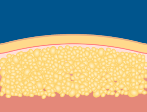 Processus de cryolipolyse étape 1