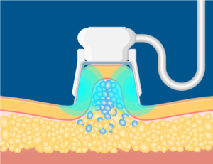 Processus de cryolipolyse étape 2