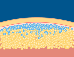 Processus de cryolipolyse étape 3