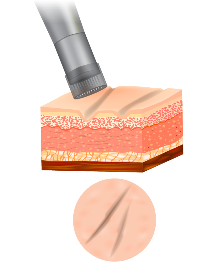 Microneedling processus : avant