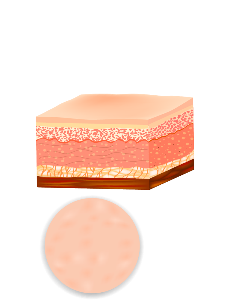 Microneedling processus : après