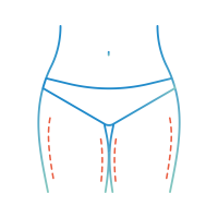 Cryolipolyse cuisses