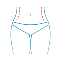 cryolipolyse hanches